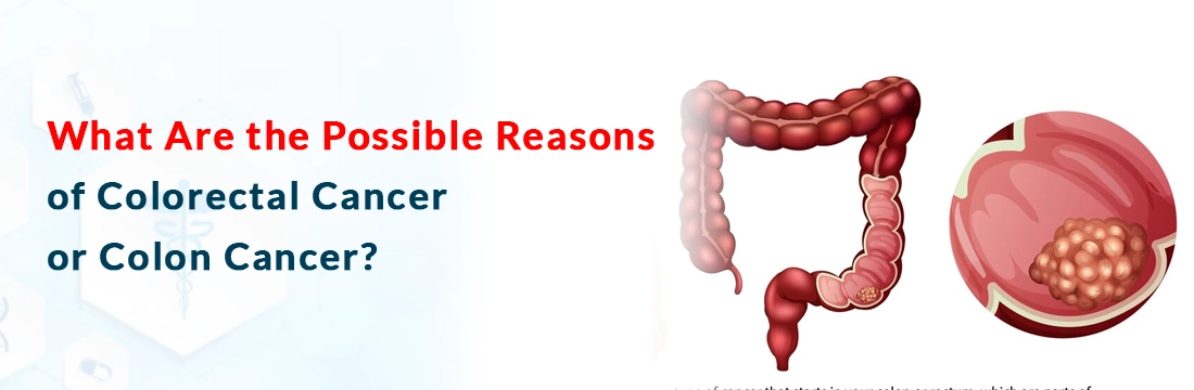  What Are the Possible Reasons of Colorectal Cancer or Colon Cancer?